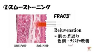 #0404 ブログに関するLINEアンケートで、FRAC3をお得に受けられる新企画！