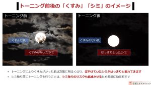 #0424  レーザートーニングは「おぼろ月夜」を「満点の夜空」に変える治療です